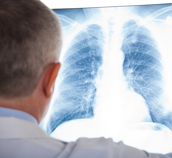 Doctor examining a lung radiography